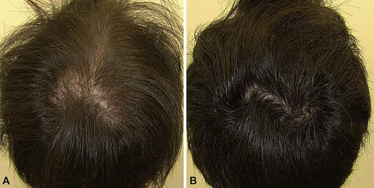 Minoxidil Before and After: Real Results