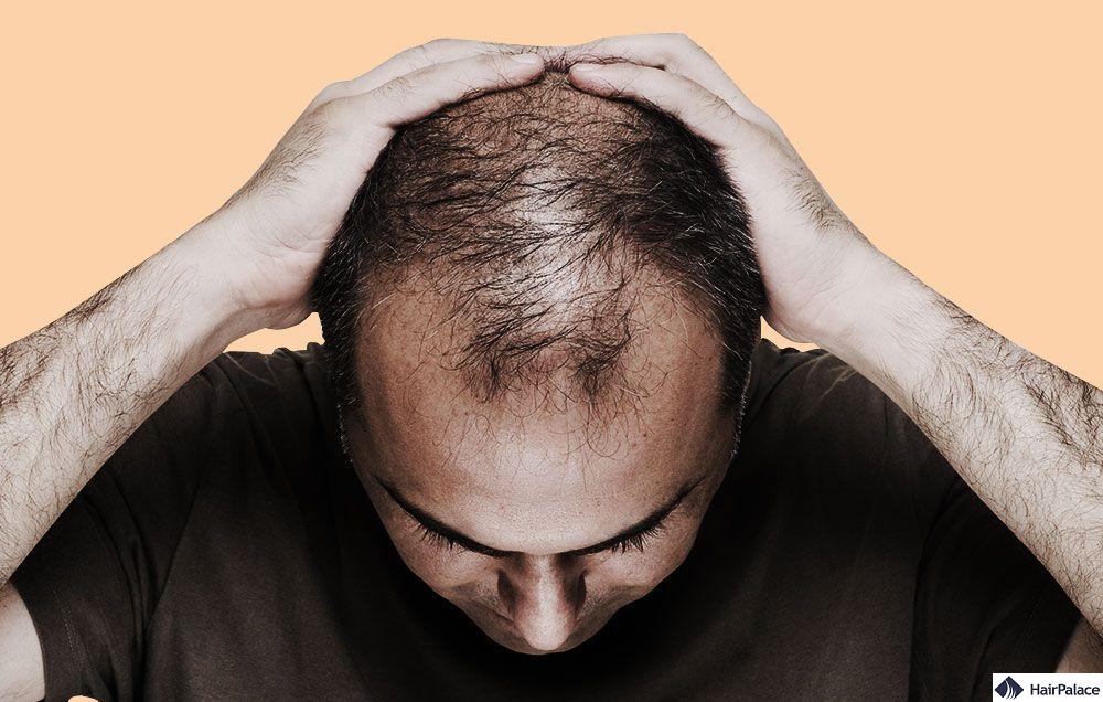 Hair Loss Myths Debunked: Separating Fact from Fiction